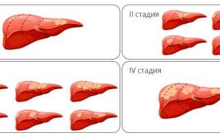 Рак печени 4 степени: проявления и борьба с заболеванием