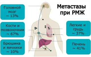 Рак груди с метастазами: подробный обзор патологии