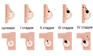 И снова РМЖ: разбор 1 стадии