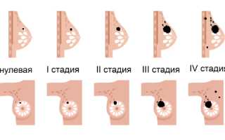И снова РМЖ: разбор 1 стадии