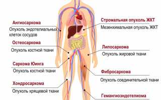 Саркома – еще одна разновидность онкозаболеваний