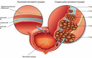 Рак мочевого пузыря: дикая правда в одной статье