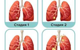 Аденокарцинома легкого: прогнозы, стадии (1, 2, 3, 4), можно ли вылечить