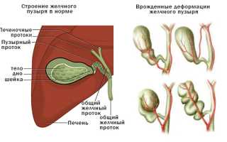 ПЕРЕГИБ ШЕЙКИ ЖЕЛЧНОГО ПУЗЫРЯ