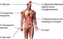 Признаки цирроза