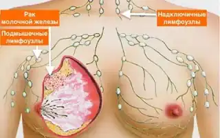 Третья стадия рака молочной железы…