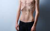 Взрослые: а как у них протекает лейкоз?