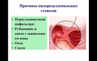 ОСЛОЖНЕНИЯ  ЯЗВЕННОЙ  БОЛЕЗНИ