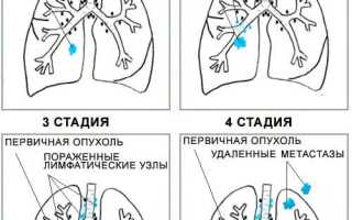 Рак легких с метастазами: нужно бороться, или шанс на выживание