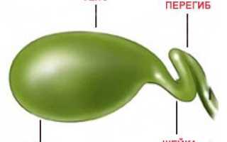 Перетяжка желчного пузыря что это такое