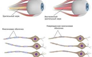 ЗАБОЛЕВАНИЯ ЗРИТЕЛЬНОГО НЕРВА