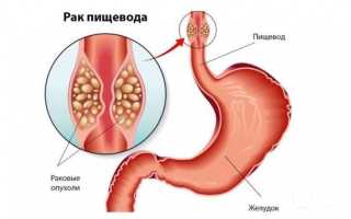 БОЛЕЗНИ ПИЩЕВОДА