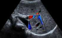 Описание узи печени