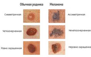 Метастатическая меланома: особенности распространения болезни