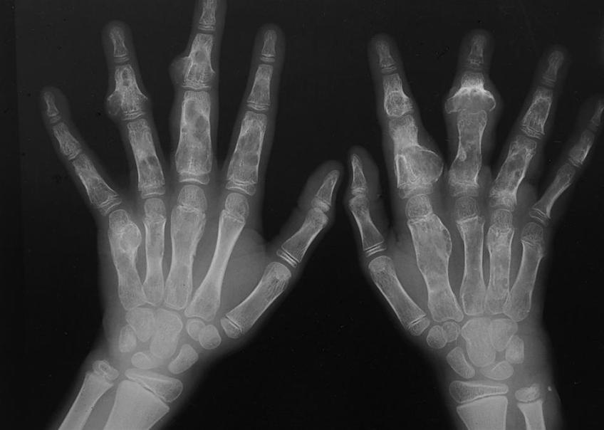 Хондрома ключицы Хондрома ключицы