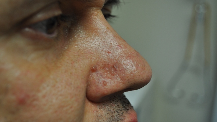 Ангиофиброма на лице у мужчины Ангиофиброма на лице у мужчины