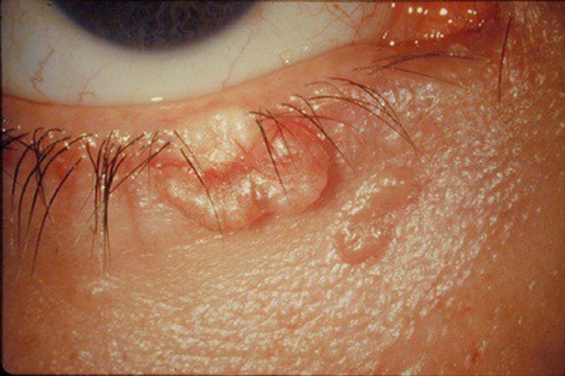 Эпителиома кожи Эпителиома кожи