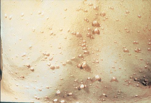 Диффузная нейрофиброма Диффузная нейрофиброма