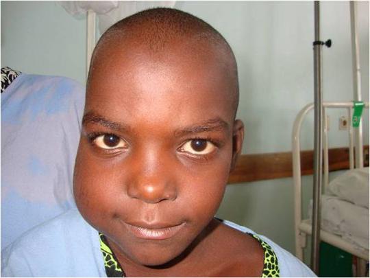 Лимфома Беркитта Лимфома Беркитта