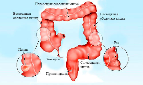Рак сигмовидной кишки Рак сигмовидной кишки