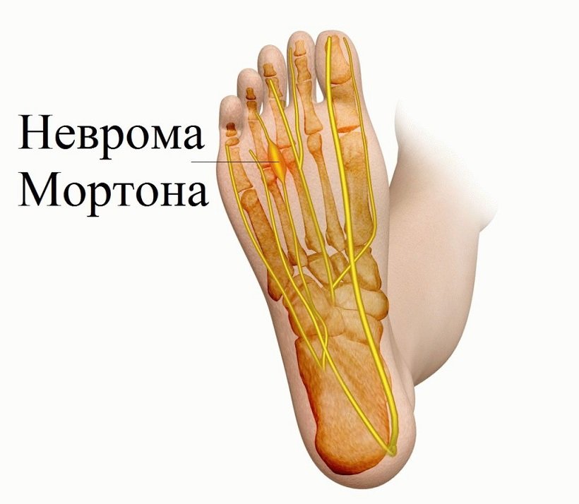 Неврома Мортона Неврома Мортона