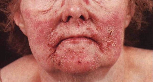 Некролитическая миграционная эритема на лице у женщины Некролитическая миграционная эритема на лице у женщины