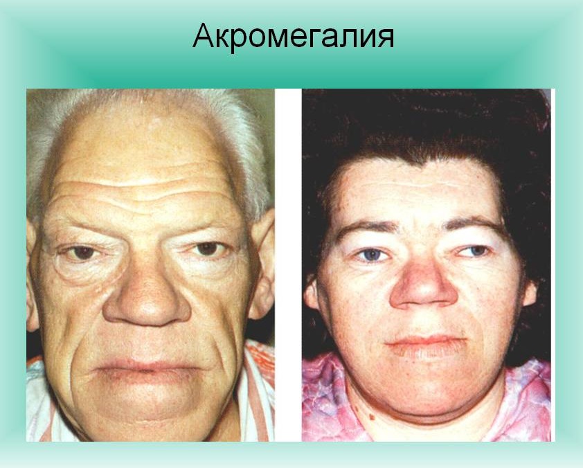акромегалия акромегалия
