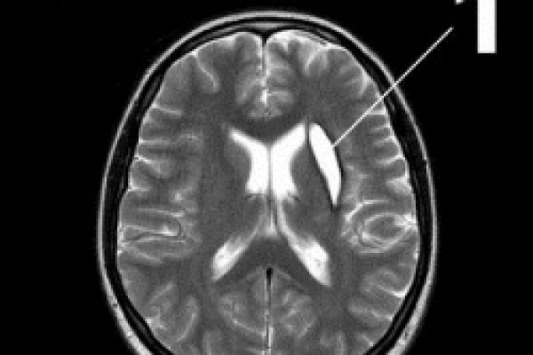 киста в голове киста в голове