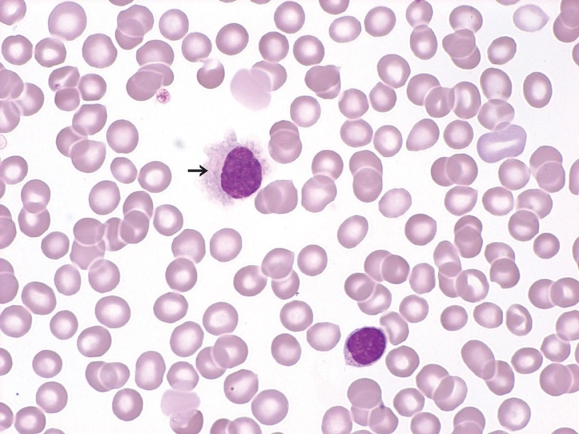 Аномальные клетки лимфы под микроскопом Аномальные клетки лимфы под микроскопом