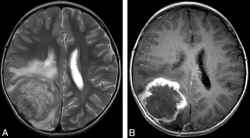Гемангиоперицитома головного мозга Гемангиоперицитома головного мозга