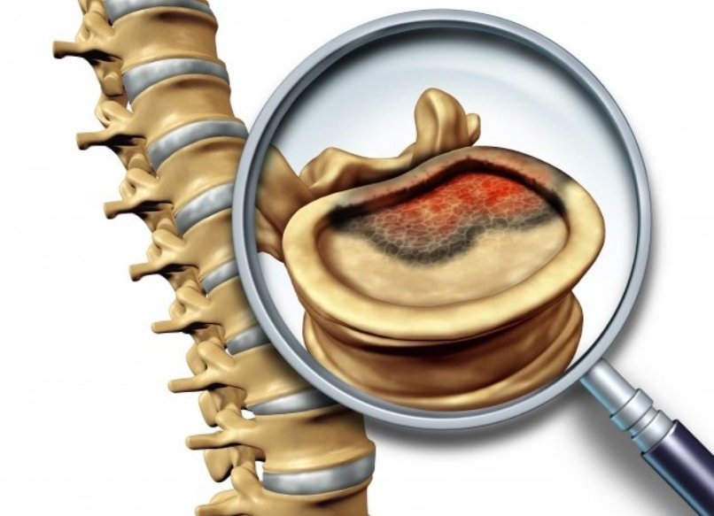 Рак позвоночника Рак позвоночника
