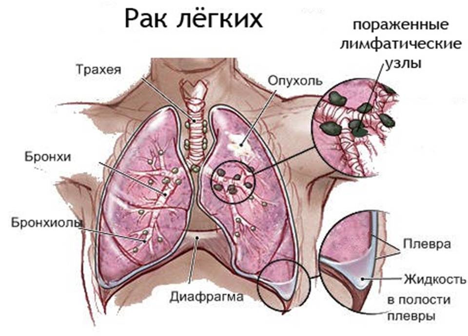 Рак легких Рак легких