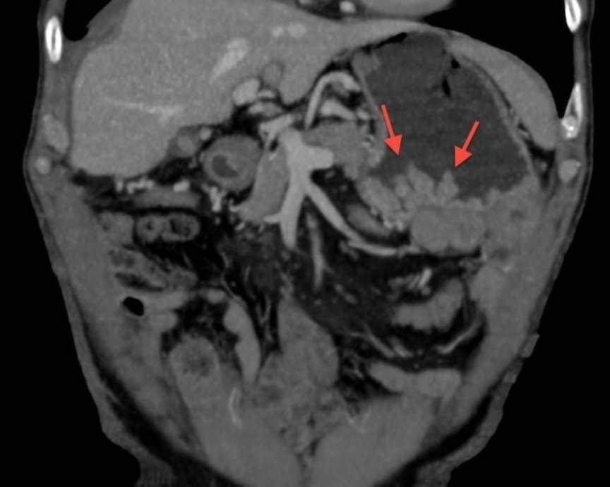 Болезнь Менетрие. Рентгеновский снимок Болезнь Менетрие. Рентгеновский снимок