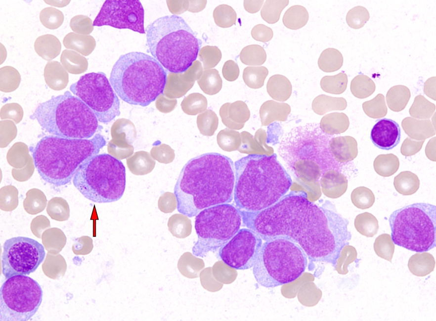 Микроскопия мазков крови больных миелолейкозом Микроскопия мазков крови больных миелолейкозом