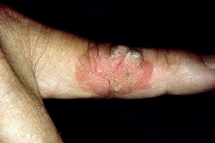 Боуэна болезнь. Фото. Боуэна болезнь. Фото.