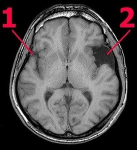 Киста головного мозга Киста головного мозга
