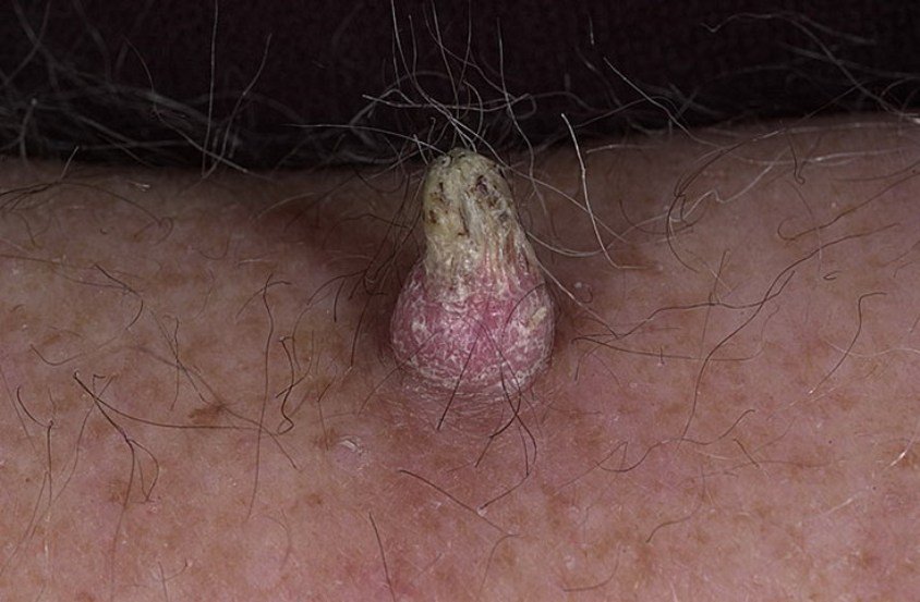 Кожный рог Кожный рог