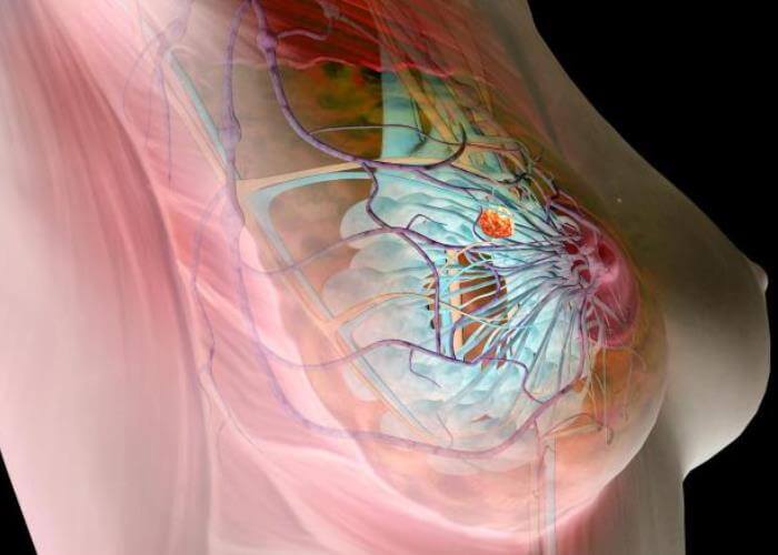 Диффузный фиброаденоматоз Диффузный фиброаденоматоз