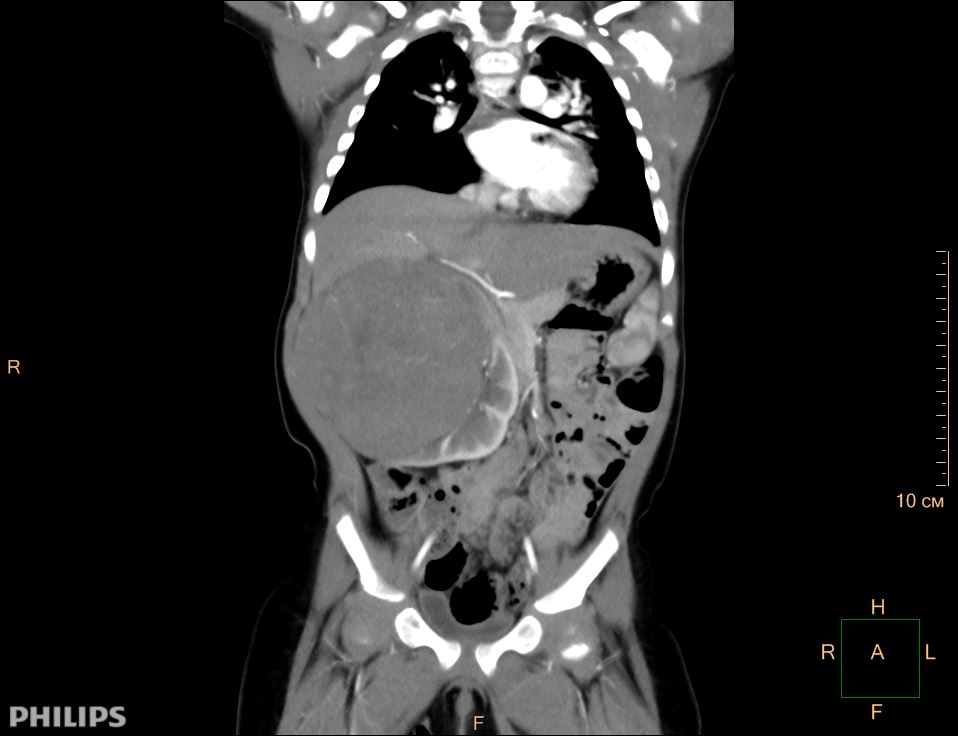 Опухоль Вильмса или нефробластома у детей Опухоль Вильмса или нефробластома у детей