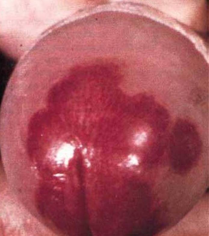 Эритроплазия Кейра Эритроплазия Кейра