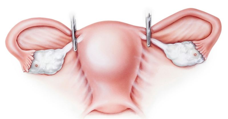 Гистерэктомия Гистерэктомия