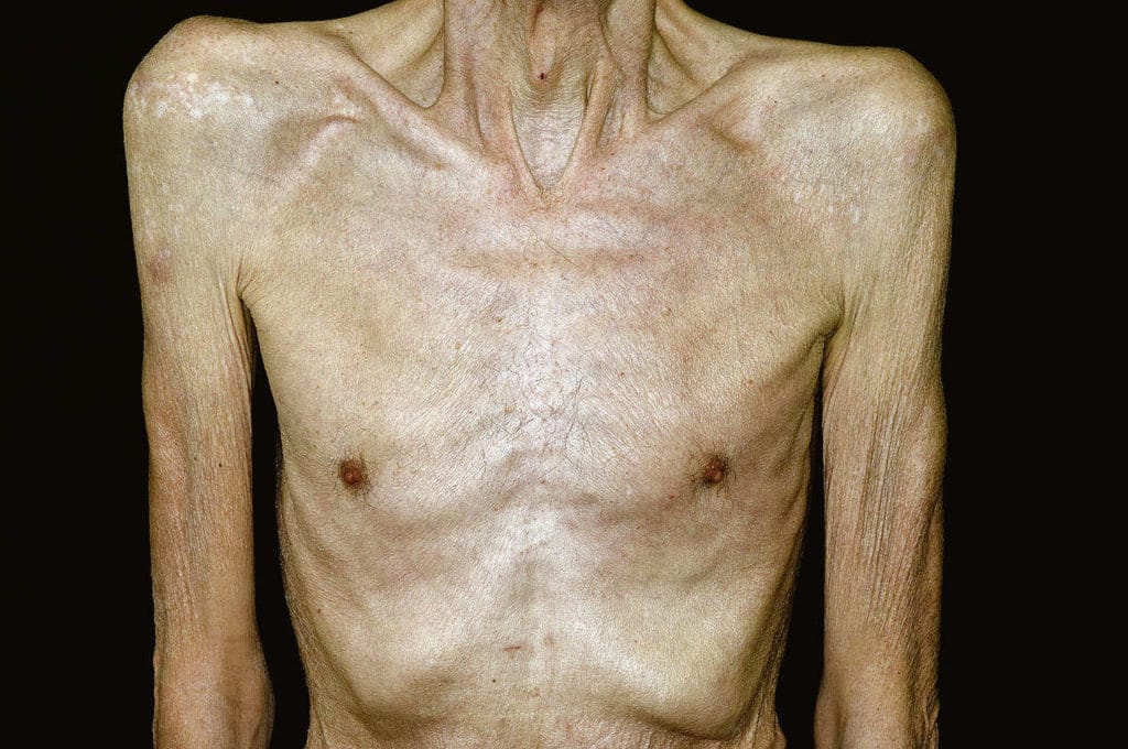 Кахексия Кахексия