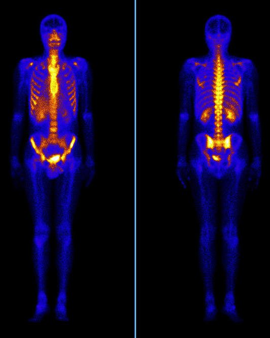 сцинтиграфия костей сцинтиграфия костей