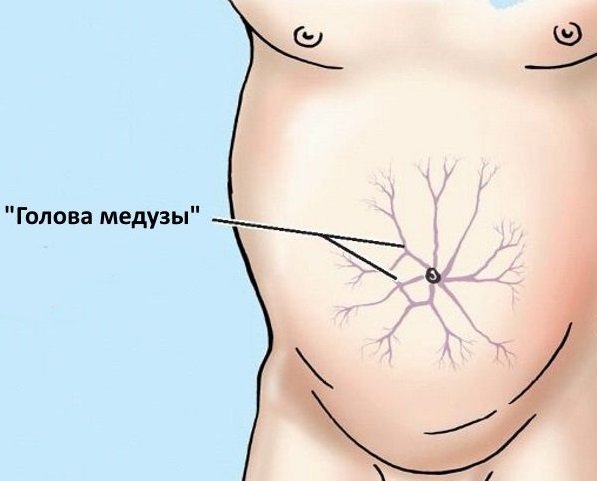 голова медузы голова медузы