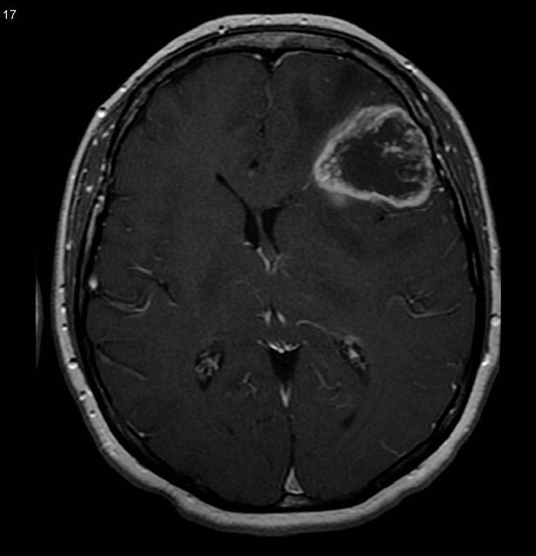 глиобластома головного мозга глиобластома головного мозга