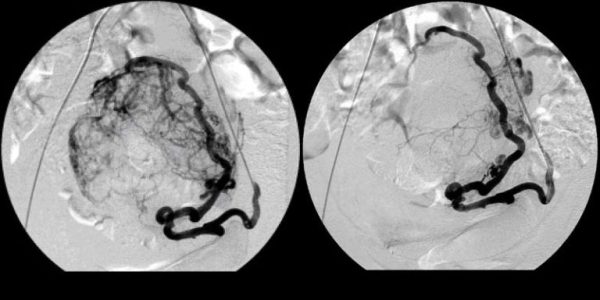 Эмболизация маточных артерий при миоме. До и после эмболизации. Эмболизация маточных артерий при миоме. До и после эмболизации.