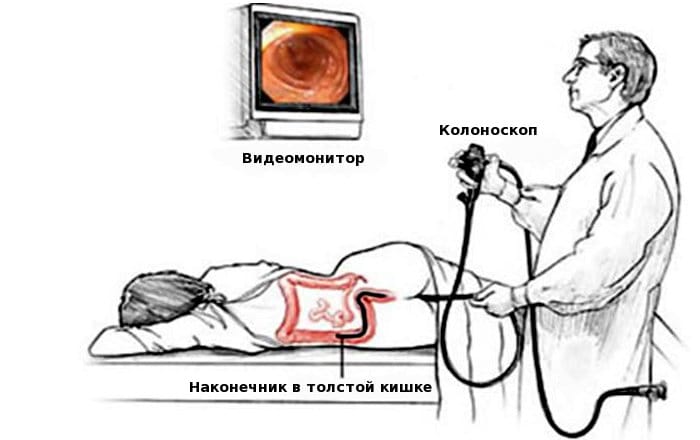 Колоноскопия Колоноскопия