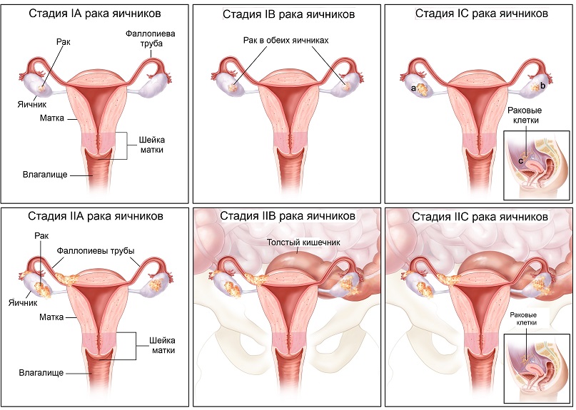 Стадии опухоли яичника Стадии опухоли яичника
