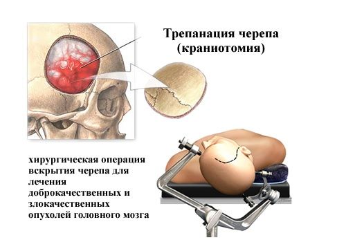 Трепанация черепа Трепанация черепа