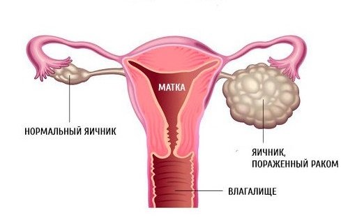 рак яичников рак яичников